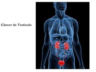 Câncer de Testículo
 