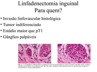 Linfadenectomia inguinal
Para quem?
• Invasão linfovascular histológica
• Tumor indiferenciado
• Estádio maior que pT1
• Gânglios palpáveis
 