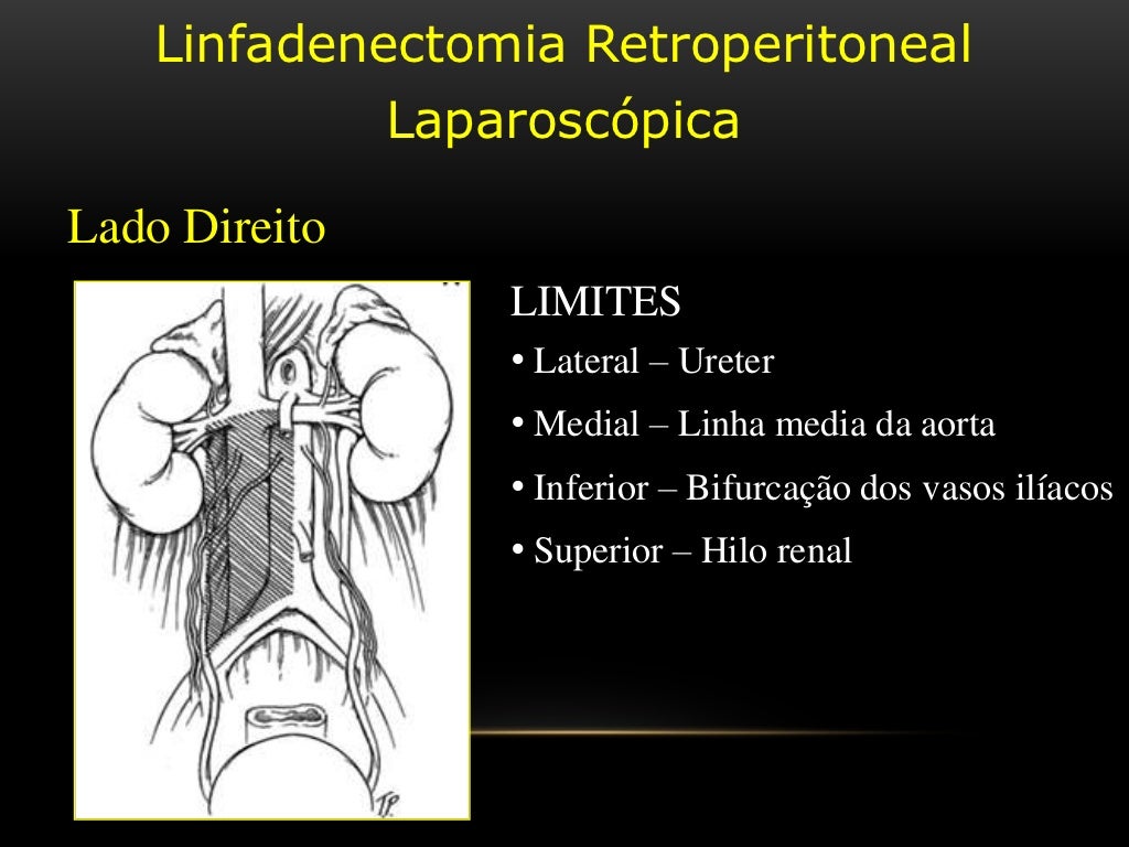 Linfadenectomia laparoscópica pélvica e retroperitoneal