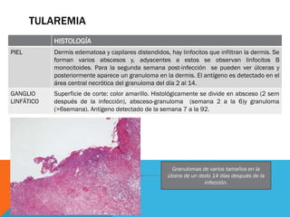 TULAREMIA




Antígenos de F. tularensis detectados en
 abscesos y zonas necróticas. (14 días     Corte de GL axilar.
    ...