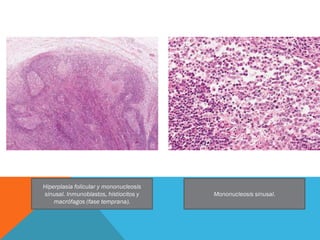 Giemsa. Histiocitos, macrófagos y   Granuloma de células epitelioides con
   linfotcitos monocitoides B.          absceso ...