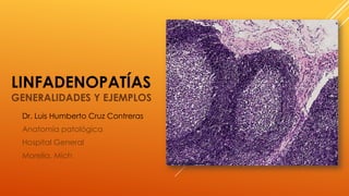 LINFADENOPATÍAS
GENERALIDADES Y EJEMPLOS
Dr. Luis Humberto Cruz Contreras
Anatomía patológica
Hospital General
Morelia, Mich
 