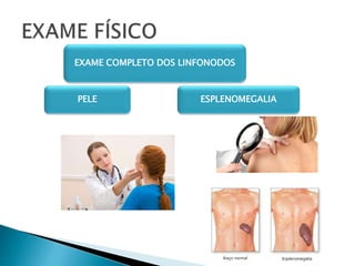 ESPLENOMEGALIAPELE
EXAME COMPLETO DOS LINFONODOS
 
