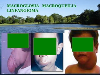 MACROGLOSIA MACROQUEILIA
LINFANGIOMA

 