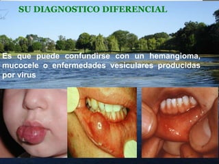SU DIAGNOSTICO DIFERENCIAL

Es que puede confundirse con un hemangioma,
mucocele o enfermedades vesiculares producidas
por virus

 