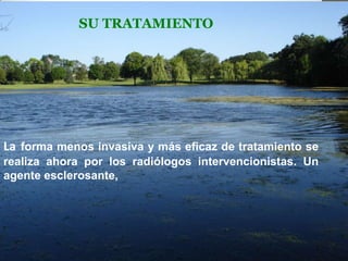 SU TRATAMIENTO

La forma menos invasiva y más eficaz de tratamiento se
realiza ahora por los radiólogos intervencionistas. Un
agente esclerosante,

 