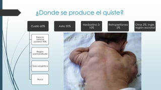 ¿Donde se produce el quiste?
Cuello 60%
Espacio
cervical
posterior 90%
Región
submandibular
Área subglotica
Nuca
Axila 30%
Mediastino 3-
10%
Retroperitoneo
2%
Otras 2%: ingle,
región escrotal