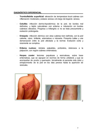 7
DIAGNÓSTICO DIFERENCIAL
- Tromboflebitis superficial: elevación de temperatura local cutánea con
inflamación moderada y estasis venosa a lo largo de trayecto venoso.
- Celulitis: infección dermo-hipodérmica de la piel, de bordes mal
definidos, y tejido subcutáneo con eritema e induración sin bordes
cutáneos elevados. Progresa a linfangitis si no se trata precozmente y
evolución prolongada.
- Erisipela: infección dérmica con área cutánea bien definida, con la piel
caliente, rubor, brillante, edematosa e indurada. Presenta bullas y una
demarcación entre la piel afectada y la normal. Evolución corta y
raramente se complica.
- Eritema nudoso: nódulos palpables, profundos, dolorosos a la
palpación, con región cutánea eritematosa.
- Herpes zoster: lesiones papulosas y vesiculosas, sobre base
eritematosa, que se agrupan en racimos de forma unilateral, y que se
acompañan de prurito y quemazón. Inicialmente el paciente nota dolor y
enrojecimiento de la piel en los días previos hasta la aparición de
vesículas.
1 2
 