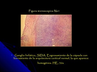 Figura microscopica No1




    Ganglio linfático, SIDA. Engrosamiento de la cápsula con
    borramiento de la arquitectura cortical normal, la que aparece
                       homogénea. HE, 32x
 