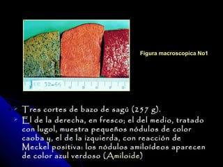Figura macroscopica No1




   Tres cortes de bazo de sagú (257 g).
   El de la derecha, en fresco; el del medio, tratado
    con lugol, muestra pequeños nódulos de color
    caoba y, el de la izquierda, con reacción de
    Meckel positiva: los nódulos amiloídeos aparecen
    de color azul verdoso ( Amiloide)
 