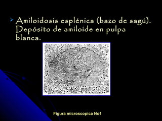    Amiloidosis esplénica (bazo de sagú).
    Depósito de amiloide en pulpa
    blanca.




              Figura microscopica No1
 
