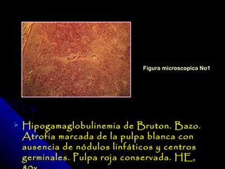 Figura microscopica No1




   Hipogamaglobulinemia de Bruton. Bazo.
    Atrofia marcada de la pulpa blanca con
    ausencia de nódulos linfáticos y centros
    germinales. Pulpa roja conservada. HE,
 