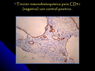Tinción inmunohistoquímica para CD31
    (negativo) con control positivo .
 