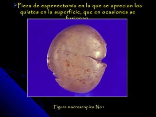 Pieza de espenectomía en la que se aprecian los
  quistes en la superficie, que en ocasiones se
                    fusionan.




              Figura macroscopica No1
 