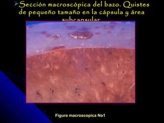 Sección macroscópica del bazo. Quistes
 de pequeño tamaño en la cápsula y área
             subcapsular.




           Figura macroscopica No1
 
