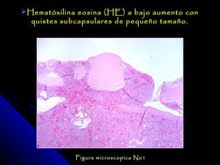 Hematóxilina eosina (HE) a bajo aumento con
  quistes subcapsulares de pequeño tamaño.




             Figura microscopica No1
 
