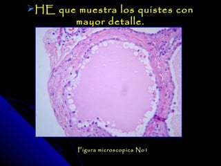 HE que muestra los quistes con
       mayor detalle.




         Figura microscopica No1
 