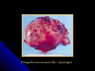Fotografía macroscópica No 1 (patología)
 