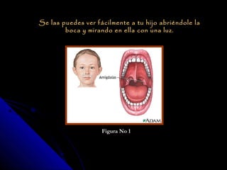 Se las puedes ver fácilmente a tu hijo abriéndole la
        boca y mirando en ella con una luz.




                    Figura No 1
 