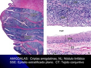 AMIGDALAS: Criptas amigdalinas, NL: Nódulo linfático
SSE: Epitelio estratificado plano. CT: Tejido conjuntivo
 