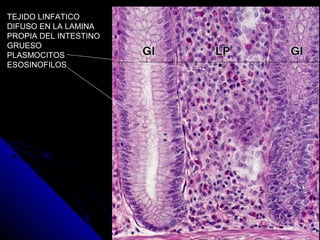 TEJIDO LINFATICO
DIFUSO EN LA LAMINA
PROPIA DEL INTESTINO
GRUESO
PLASMOCITOS
ESOSINOFILOS
 