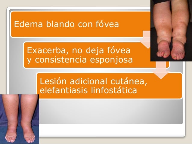 Linfedema
