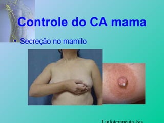 Controle do CA mama
• Secreção no mamilo
 