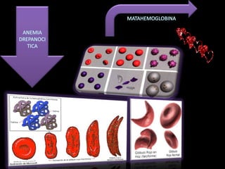 MATAHEMOGLOBINAANEMIA DREPANOCITICA