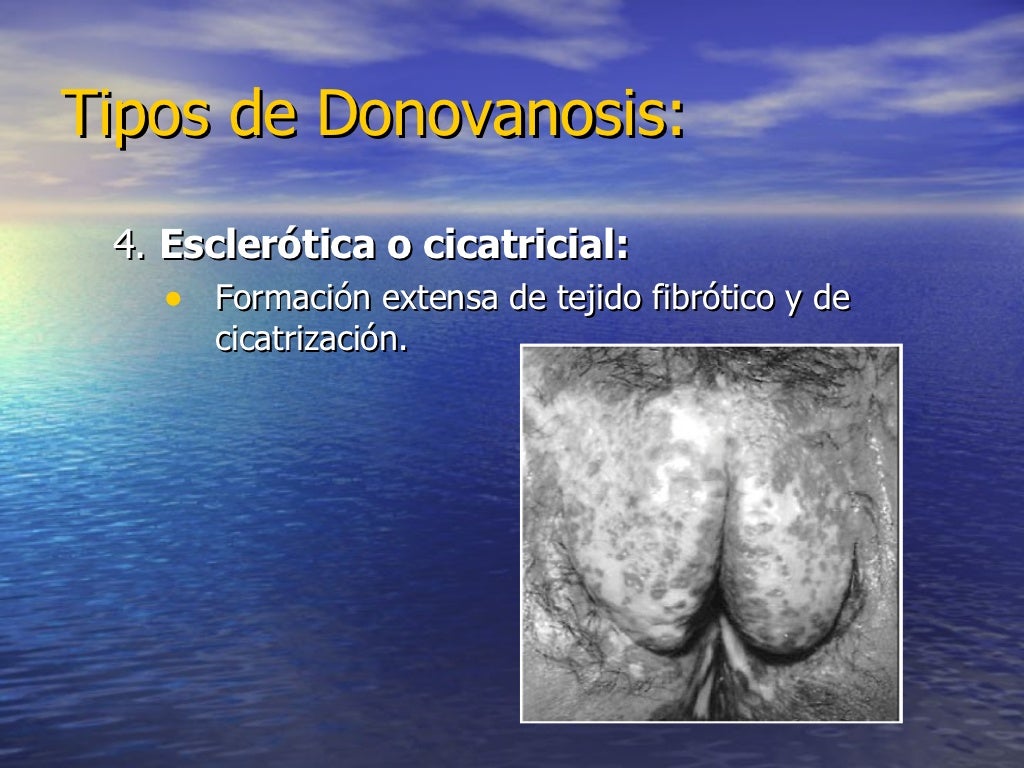 Venereo Linfogranuloma venereo y Donovanosis