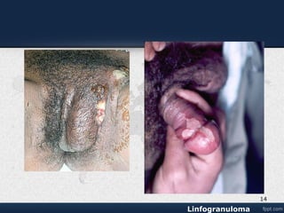 Úlcera pequeña e indolora en los órganos
genitales o en el tracto genital femenino.
Hinchazón y enrojecimiento de la piel en
el área inguinal
Ganglios linfáticos inguinales inflamados
en uno o ambos lados; también puede
afectar los ganglios linfáticos alrededor del
recto en aquellos que tienen relaciones
sexuales anales
Supuración en la piel de los ganglios
linfáticos inguinales
Flujo de pus o sangre del recto (sangre en
las heces)
Dolor con las deposiciones (tenesmo)
Hinchazón de los labios
SINTOMAS
14
 