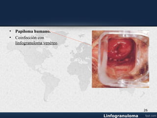 Prevención
• • Limite la cantidad de compañeros sexuales.
• • Utilice condón.
• • Lave sus genitales a fondo después de las relaciones sexuales.
• • Si usted piensa que pueda estar infectado(a), evite el contacto sexual y
acuda a su clínica local de EST, a un hospital o visite a su médico.
• • Notificar a todos sus contactos sexuales de inmediato para que puedan
ser examinados y tratados.
26
 