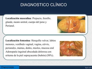 Chancro en región anal.
• En estos casos aparece una úlcera dolorosa en la piel de la región anal.
• Por la ubicación de la úlcera, con frecuencia se producen molestias para
defecar, sangrado y dolor rectal.
• En la mitad de los casos, a las dos semanas de aparecida la úlcera, los
ganglios se inflaman, se vuelven dolorosos y drenan espontáneamente.
32
Chancroide
 