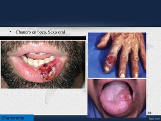 Diagnostico diferencial
38
• Sifilis.
Chancroide
 