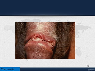 Complicaciones
• En el caso del contagio anal, esta infección puede crear estrechez en el ano,
cuadro bastante complejo y difícil de tratar.
• En los hombres se produce epididimitis (sobre todo en los menores de 35
años), artritis reactiva y Síndrome de Reiter.
• Lesiones en meato urinario, como fístulas, y una estrechez del prepucio
que puede provocar un cuadro conocido como fimosis. En ese caso, al
retraer el prepucio hacia atrás se genera dolor, al extremo de imposibilitar
las relaciones sexuales
• En las mujeres, las complicaciones comprender artritis reactiva,en el que
la infección del peritoneo perihepática por clamidias puede simular una
colecistitis. Provoca con frecuencia embarazo ectópico e infertilidad.
• La madre puede transmitir la infección a su hijo durante el nacimiento y
causarle neumonía o infección ocular.
•
39
Chancroide
 