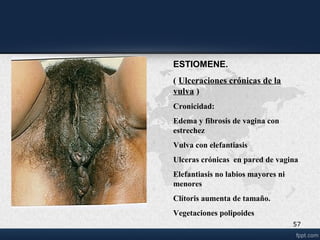 Linfogranuloma venereo