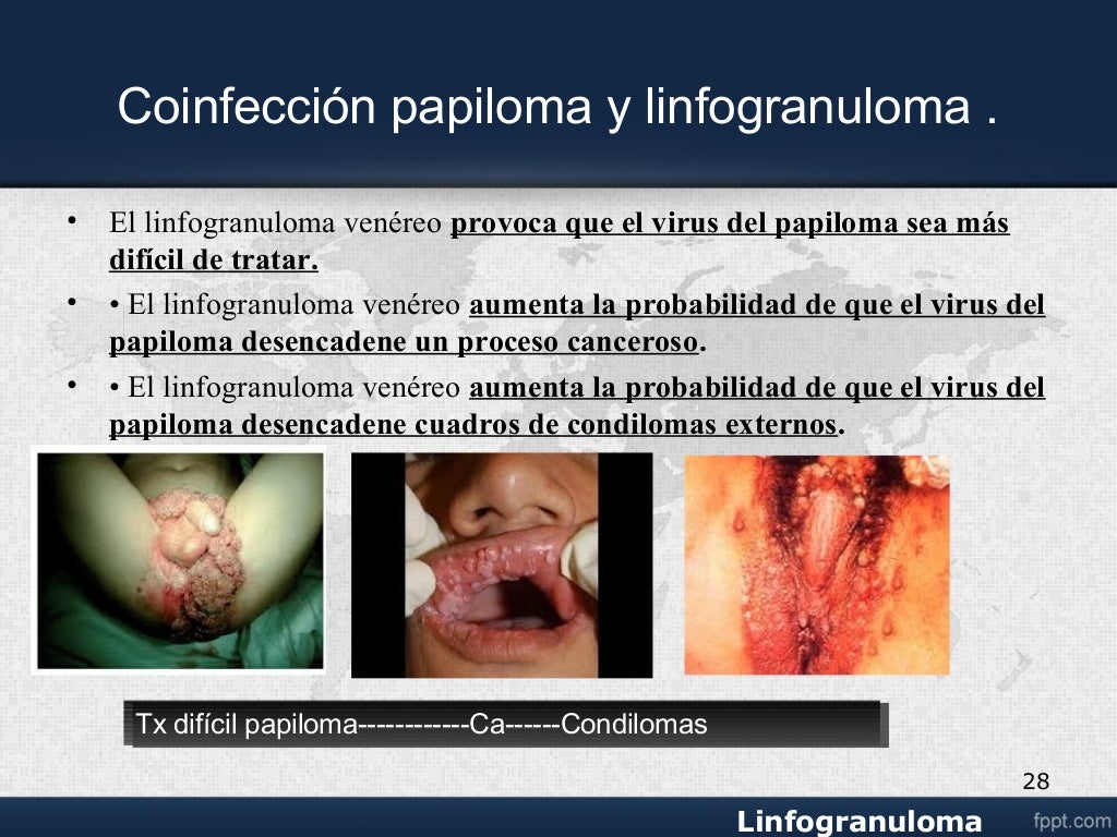 Linfogranuloma venereo