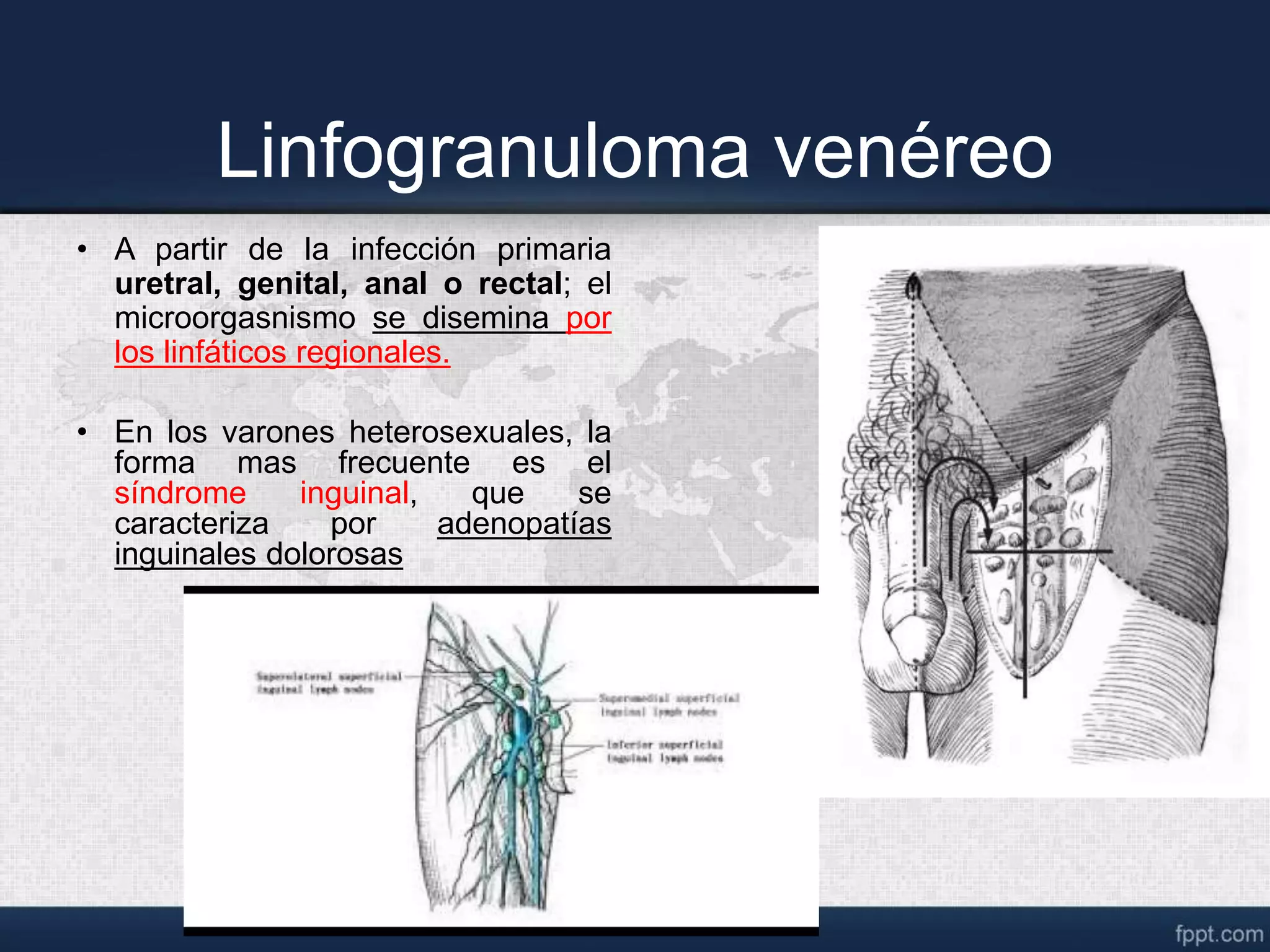 Venereo linfogranuloma venereo.ppt