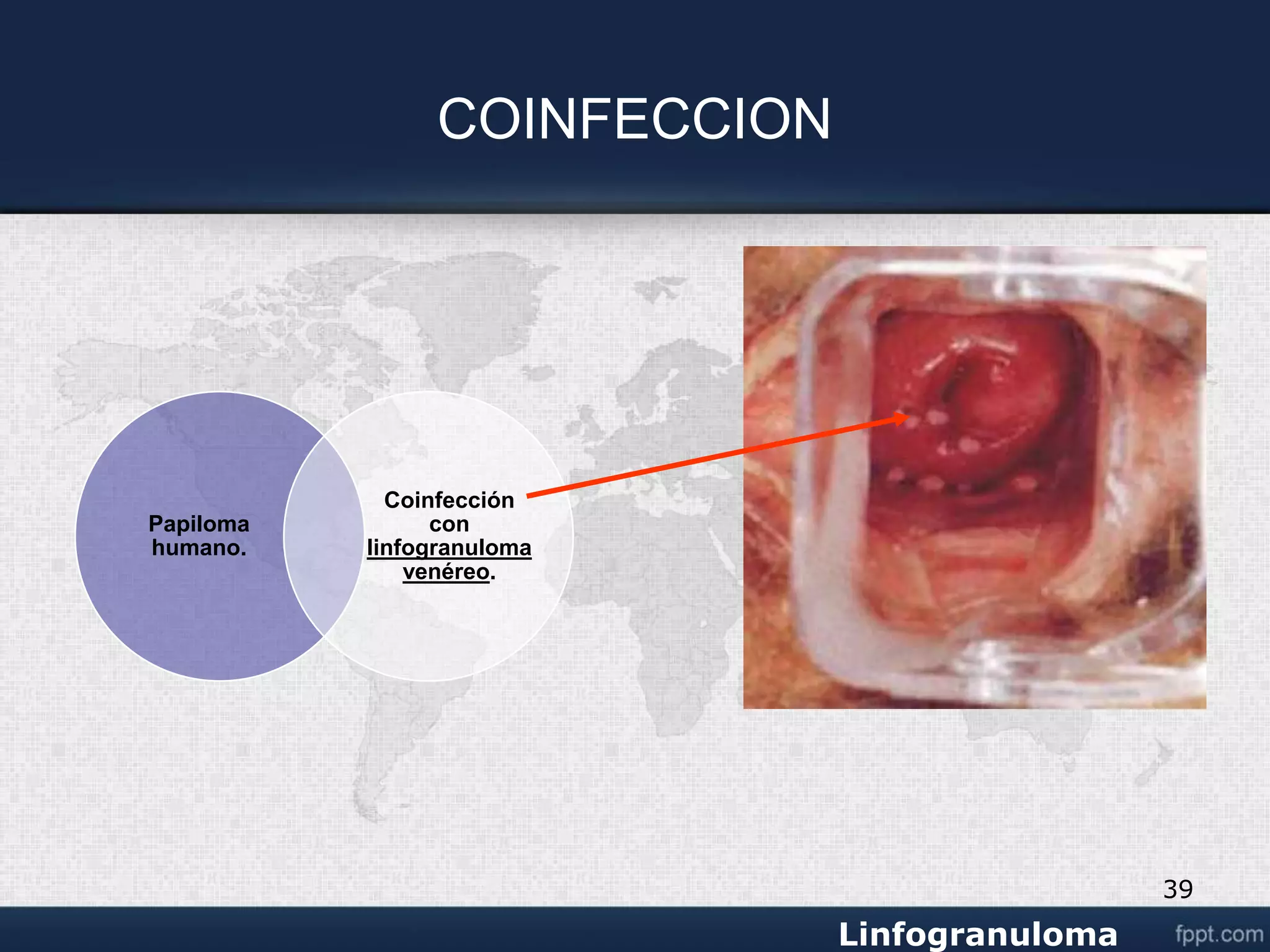 Venereo linfogranuloma venereo.ppt