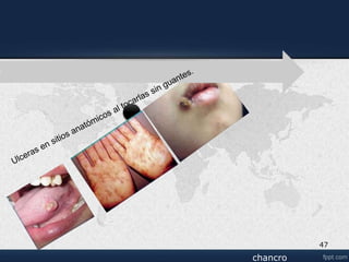 Venereo linfogranuloma venereo.ppt