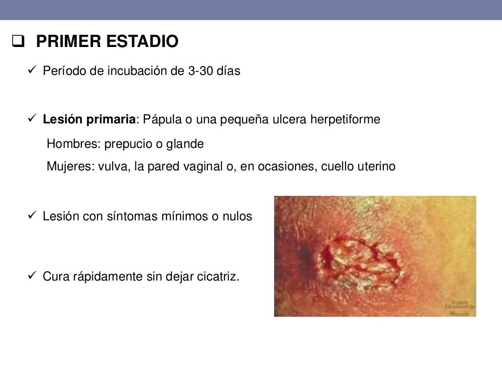Linfogranuloma venéreo