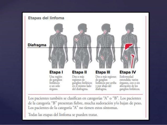 Resultado de imagen para ETAPAS DEL LINFOMA
