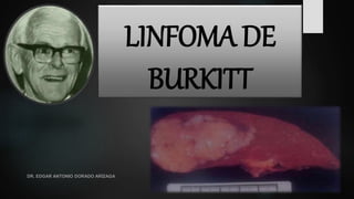 LINFOMA DE
BURKITT
DR. EDGAR ANTONIO DORADO ARÍZAGA
 