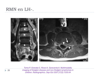 RMN en LH-.

26

Toma P, Granata C, Rossi A, Garaventa A. Multimodality
imaging of Hodgkin disease and non-Hodgkin lymphom...