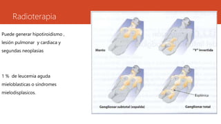 Radioterapia 
Puede generar hipotiroidismo , 
lesión pulmonar y cardiaca y 
segundas neoplasias 
1 % de leucemia aguda 
mieloblasticas o síndromes 
mielodisplasicos. 
 