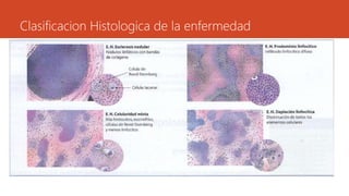 Clasificacion Histologica de la enfermedad 
 