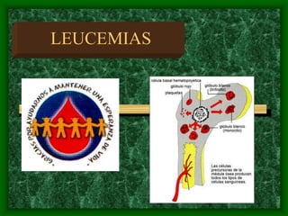 LEUCEMIAS
 