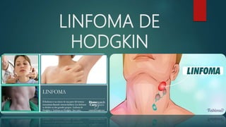 LINFOMA DE
HODGKIN
 