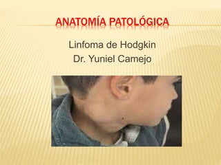 ANATOMÍA PATOLÓGICA
Linfoma de Hodgkin
Dr. Yuniel Camejo
 