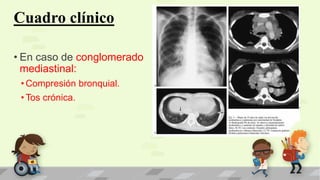 Cuadro clínico
• En caso de conglomerado
mediastinal:
• Compresión bronquial.
• Tos crónica.
 