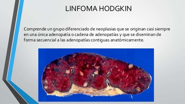 Linfoma hodgkin y no hodgkin